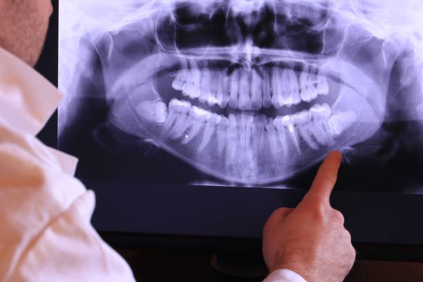 Best Emergency Wisdom Teeth Removal in Fond Du Lac, WI