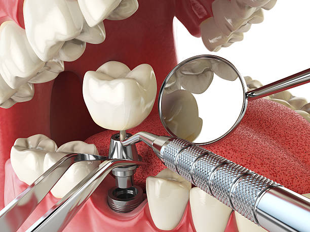 Best Emergency Treatment for Dental Infections or Abscesses in Fond Du Lac, WI